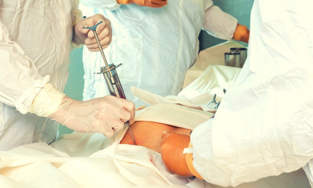 Autologous Stem Cell Transplant in India - Cost & Procedure