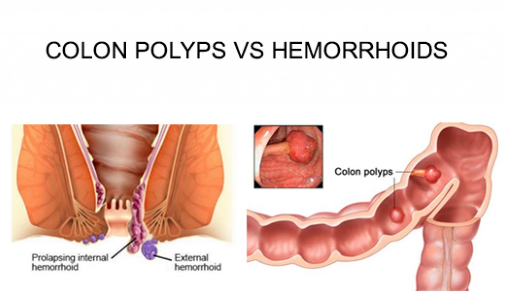 How do you tell the difference between a Hemorrhoid and a Polyp?