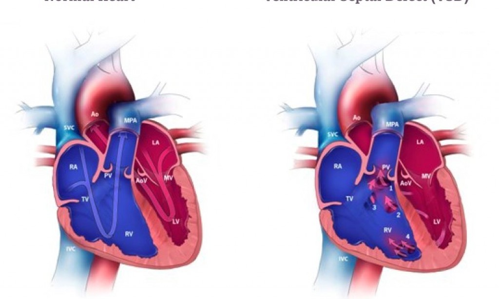 Everything You Need to Know About Ventricular Septal Defect (VSD) Closure Surgery